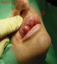 Ассоциация слов - facialfillers5