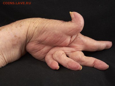 145 - rheumatoid-fingers
